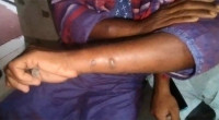 11 diagnosed with anthrax symptoms in Gaibandha