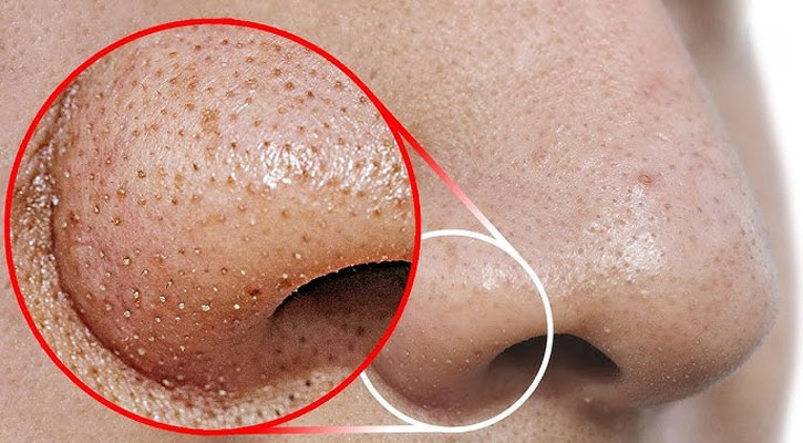 নাকের ডগায় ভরে যাচ্ছে ব্ল্যাকহেডস?